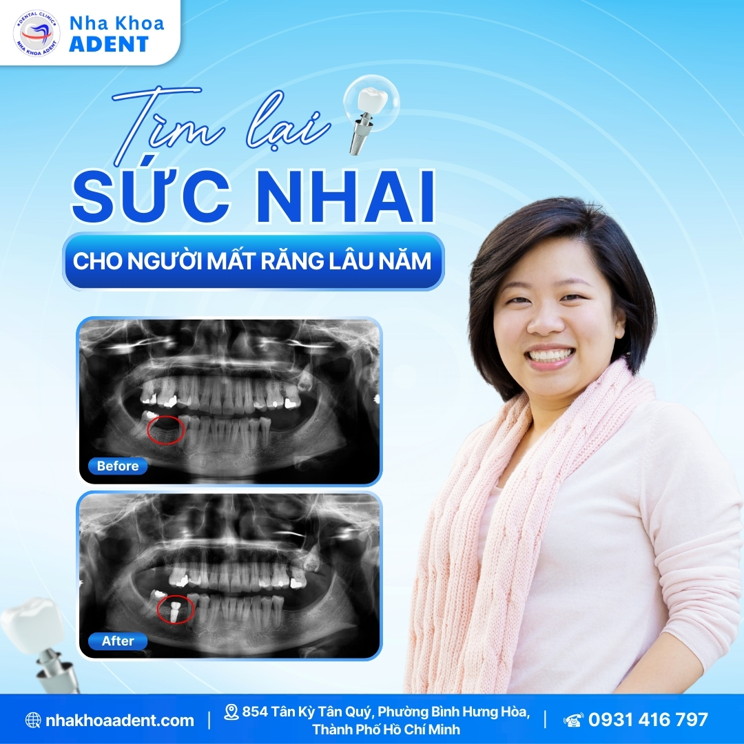 Trồng Răng Implant Uy Tín Bình Tân Tại Nha Khoa Adent