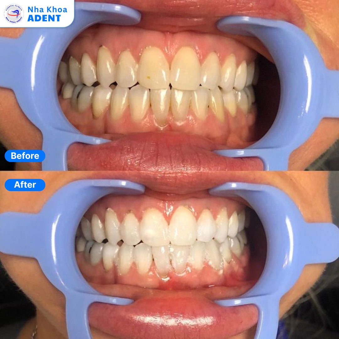 Ưu ĐÃi LÀm RĂng ĐÓn TẾt TẠi Nha Khoa Adent (6)