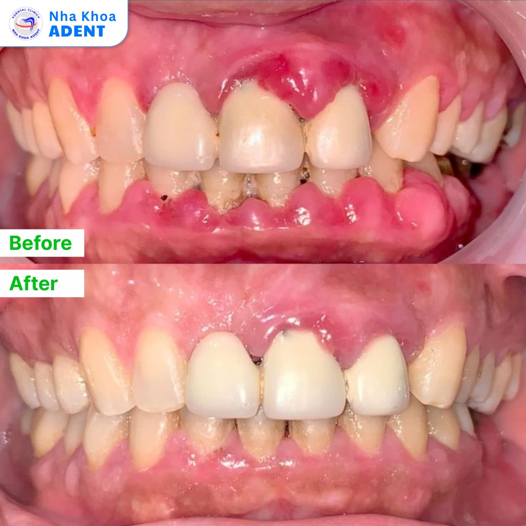 Cạo Vôi Răng Giá Bao Nhiêu