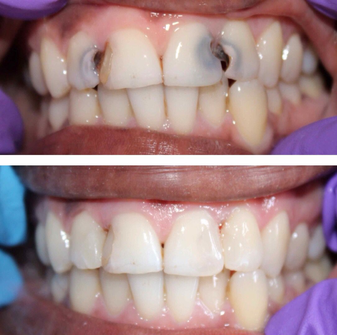 Viêm Tủy Răng Có Nguy Hiểm Không