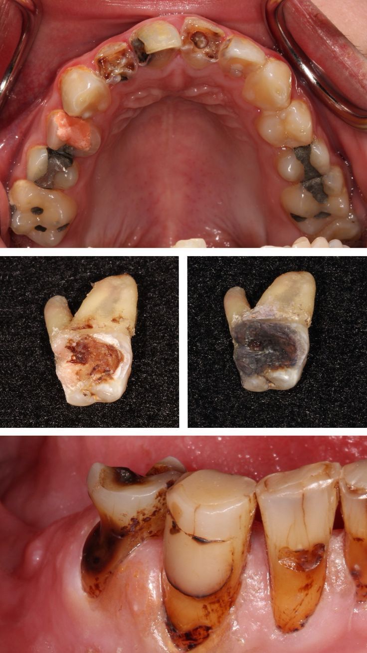 Viêm Tủy Răng Có Nguy Hiểm Không