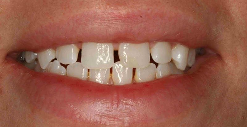 Vì Sao Răng Thưa Nguyên Nhân Và Cách Khắc Phục