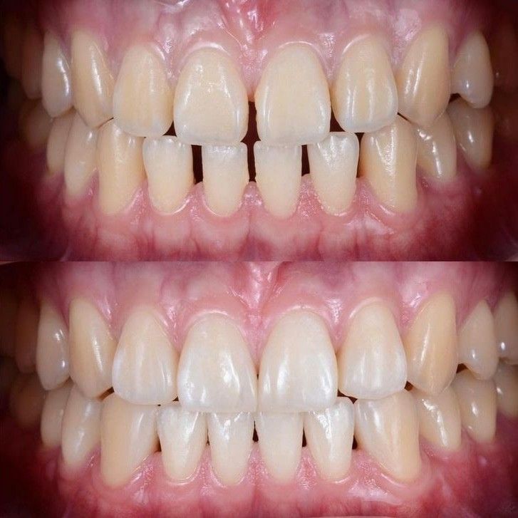 Vì Sao Răng Thưa Nguyên Nhân Và Cách Khắc Phục