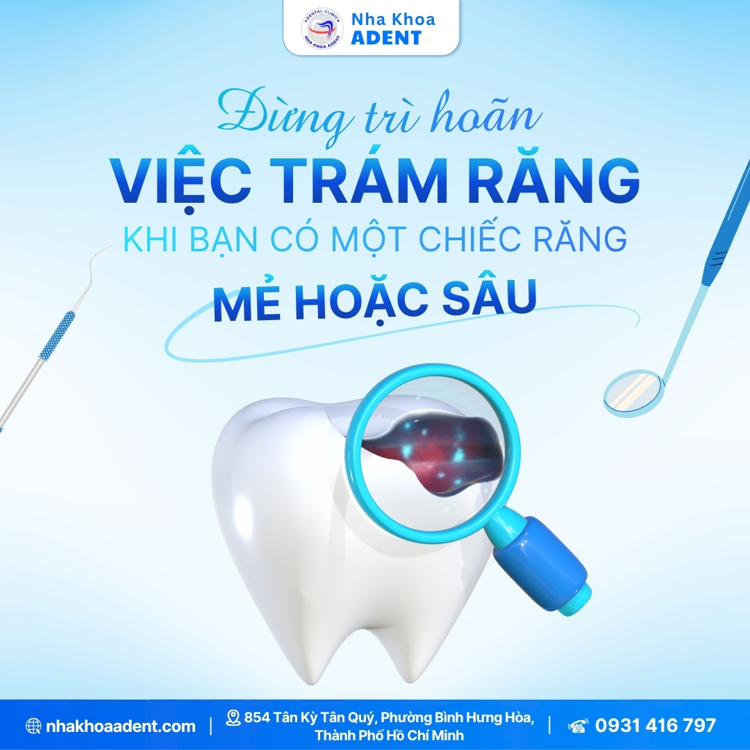5 Trường Hợp Nên Trám Răng