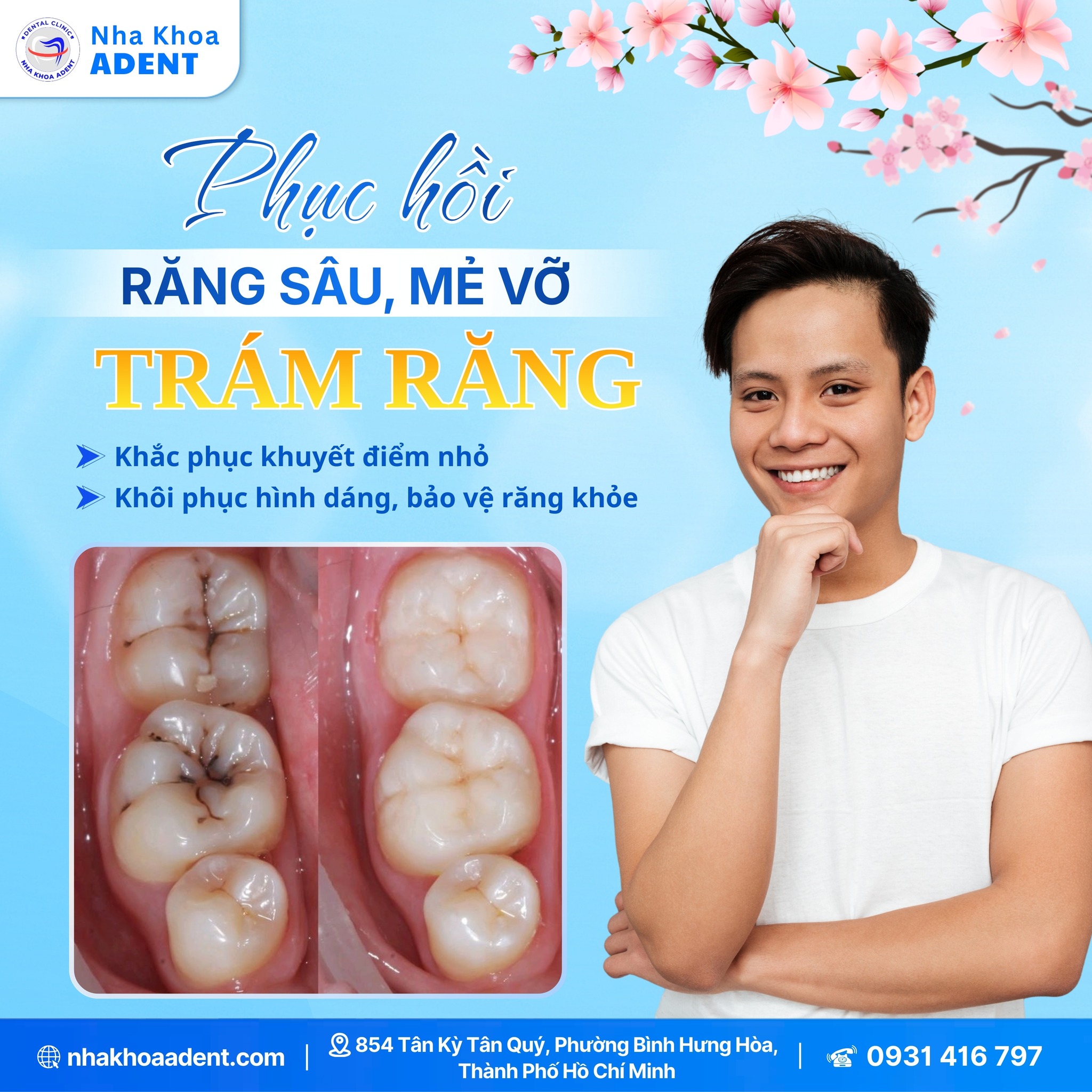 5 Trường Hợp Nên Trám Răng