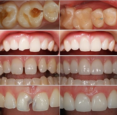 5 Trường Hợp Nên Trám Răng