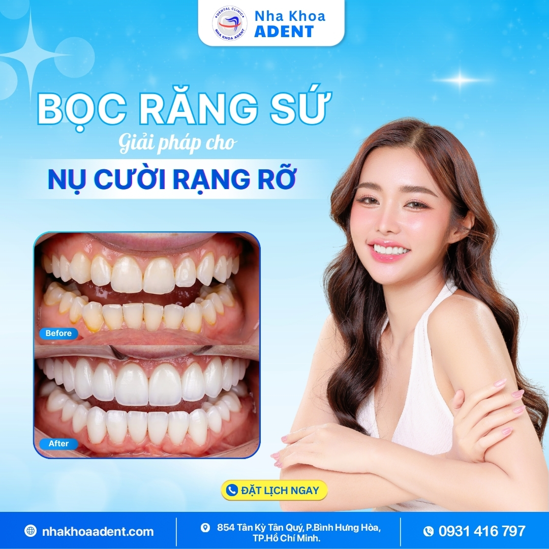 Bảng Giá Bọc Răng Sứ Mới Nhất 2025