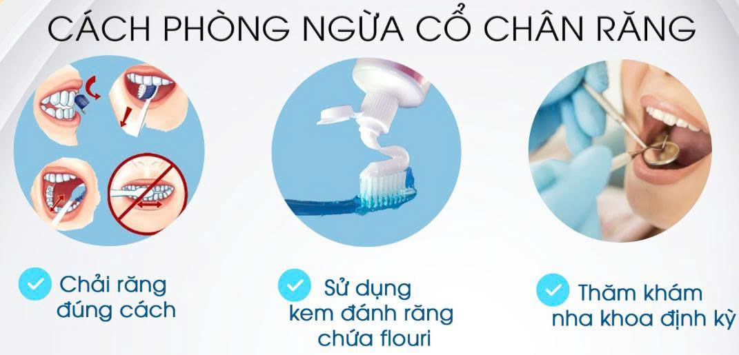 Mòn Cổ Chân Răng Là Gì