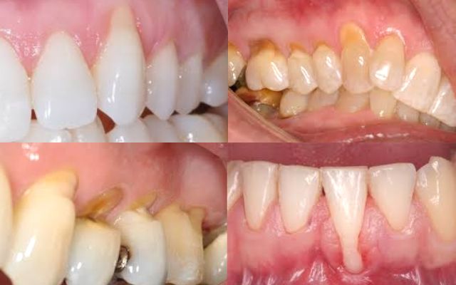 Mòn Cổ Chân Răng Là Gì