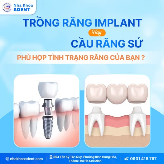 Nên Trồng Răng Implant Hay Cầu Răng Sứ