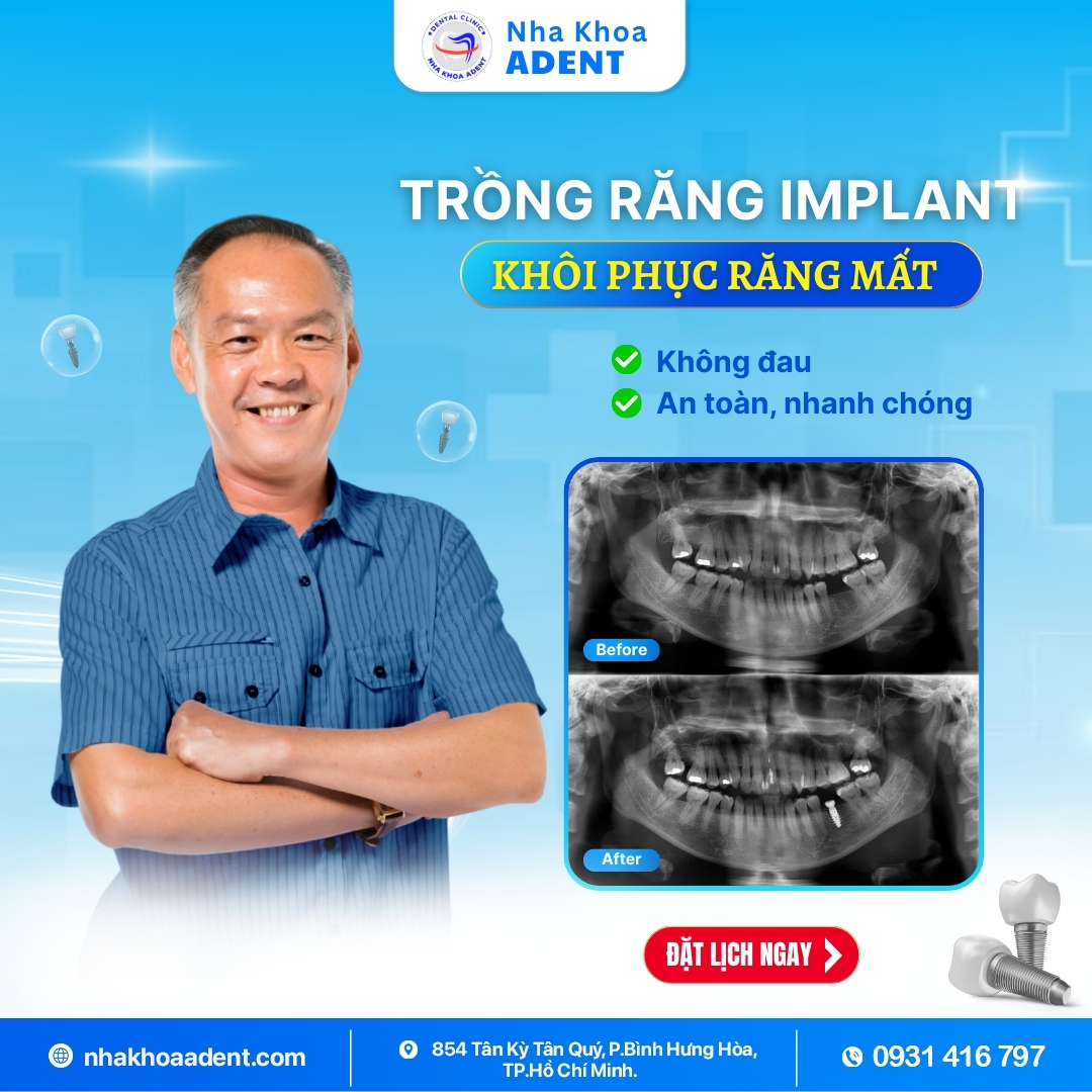 Nên Trồng Răng Implant Hay Cầu Răng Sứ