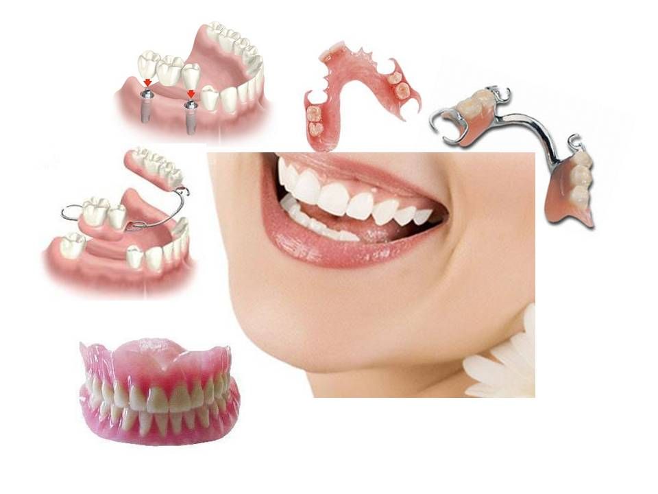 Nên Trồng Răng Implant Hay Cầu Răng Sứ