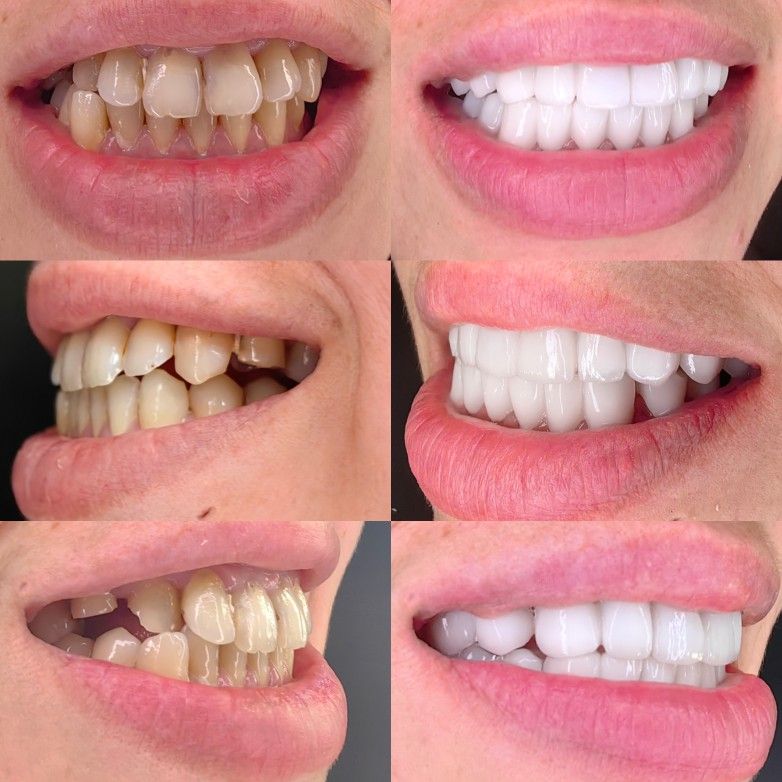 RĂng ToÀn SỨ LÀ GÌ CÓ NÊn BỌc RĂng ToÀn SỨ KhÔng