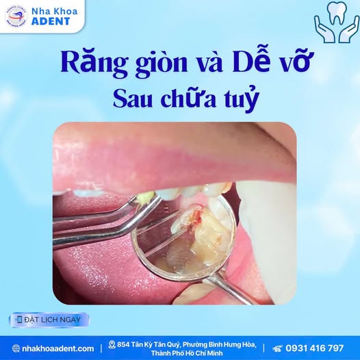 Răng Giòn Và Dễ Vỡ Sau Khi Chữa Tủy Vì Sao Cần Bọc Sứ Bảo Vệ (2)
