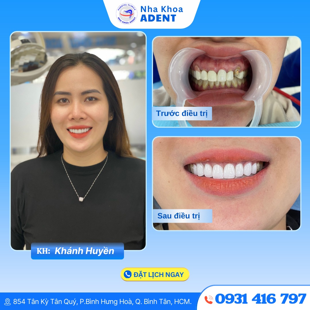 Bảng Giá Bọc Răng Sứ Mới Nhất 2025