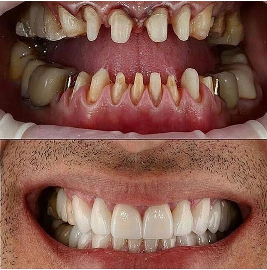 Ưu Và Nhược Điểm Bọc Răng Sứ – Giải Đáp Chi Tiết Từ Nha Khoa Adent (4)