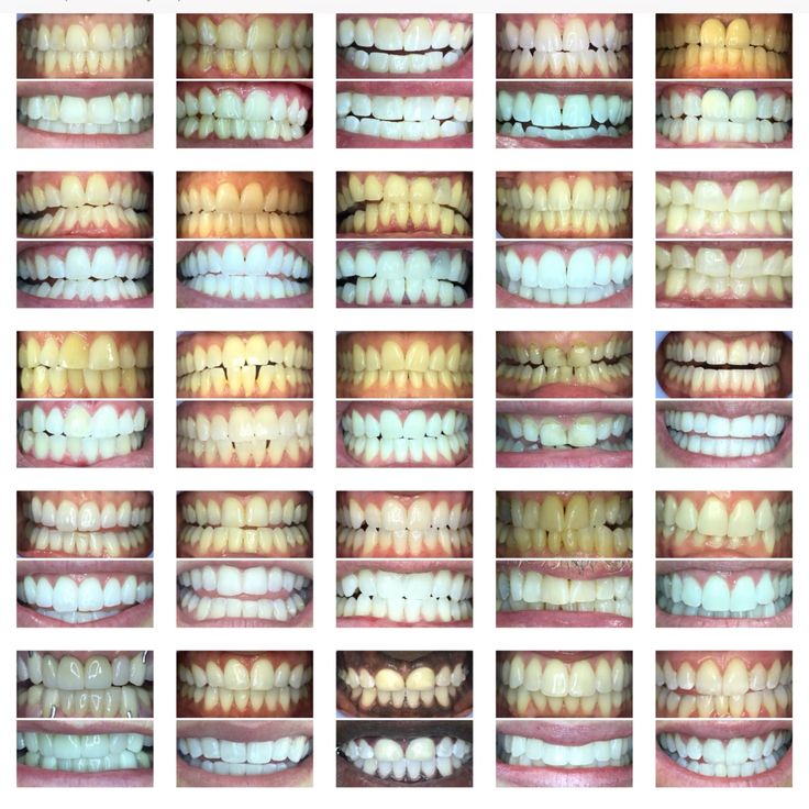 Ưu Và Nhược Điểm Bọc Răng Sứ – Giải Đáp Chi Tiết Từ Nha Khoa Adent (5)