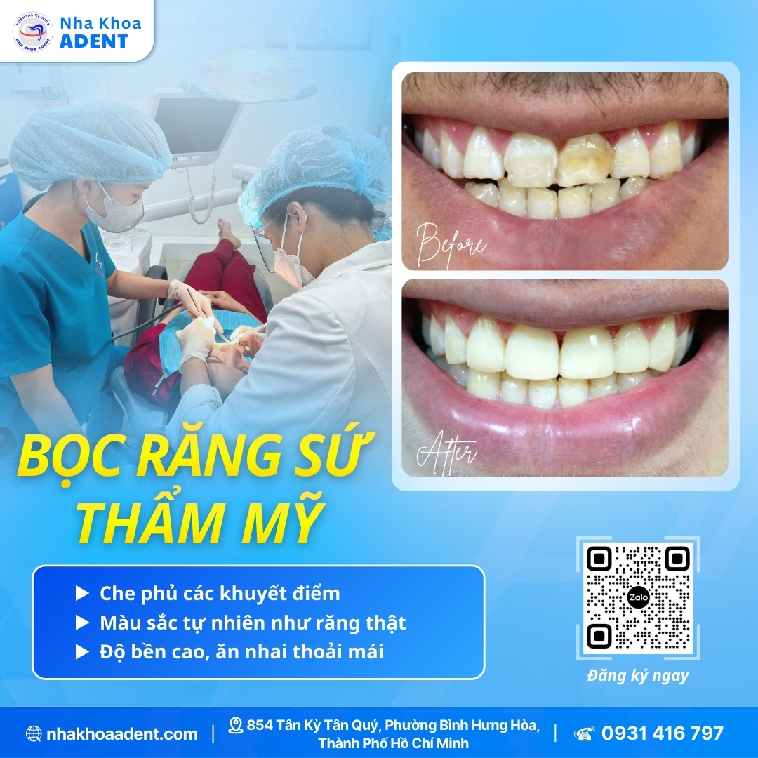 Ưu Và Nhược Điểm Bọc Răng Sứ – Giải Đáp Chi Tiết Từ Nha Khoa Adent (6)