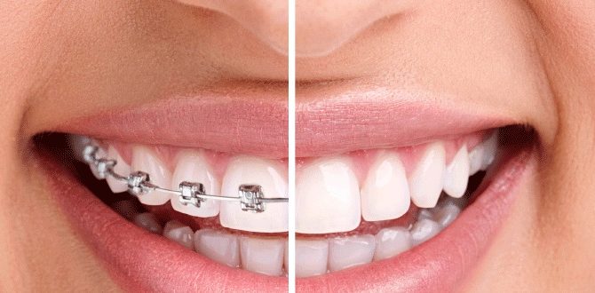 Bọc Răng Sứ Có Niềng Được Không