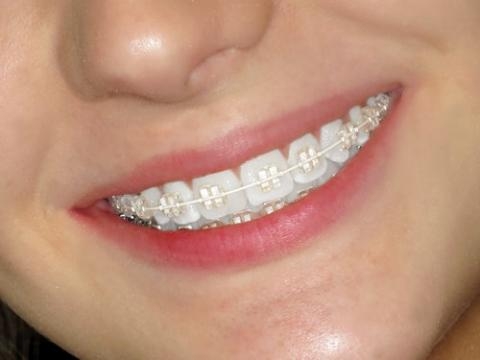 Bọc Răng Sứ Có Niềng Được Không