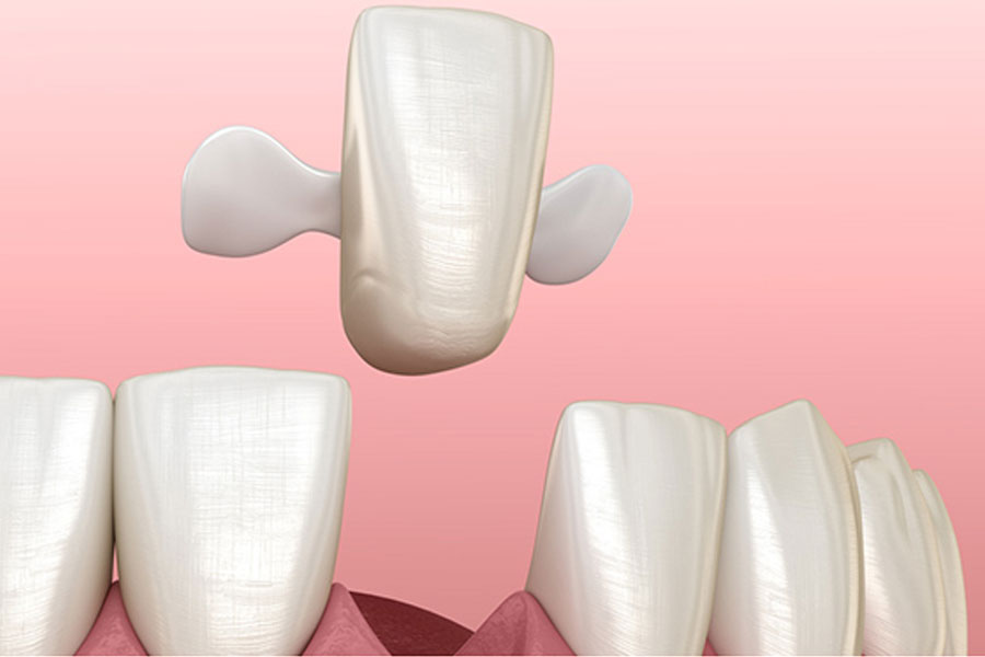 Cầu Răng Sứ Là Gì Ưu Và Nhược Điểm Của Cầu Răng Sứ