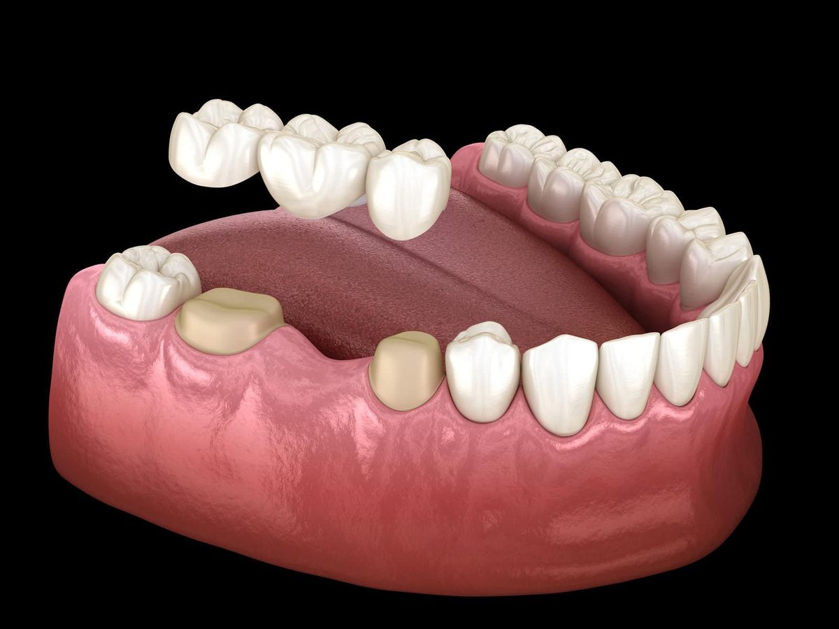 Cầu Răng Sứ Là Gì Ưu Và Nhược Điểm Của Cầu Răng Sứ