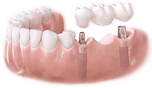 Cầu Răng Sứ Là Gì Ưu Và Nhược Điểm Của Cầu Răng Sứ