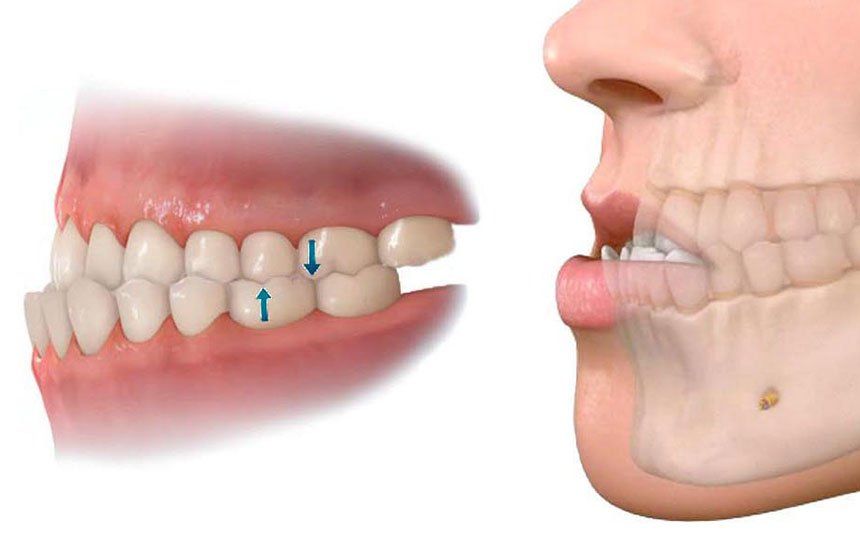 Khớp Cắn Ngược Là Gì Nguyên Nhân Và Cách Điều Trị Tại Nha Khoa Adent (3)