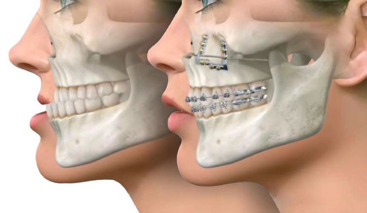 Khớp Cắn Ngược Là Gì Nguyên Nhân Và Cách Điều Trị Tại Nha Khoa Adent (4)