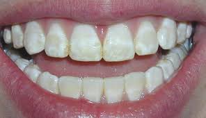 Răng Ố Vàng Nguyên Nhân Và Cách Khắc Phục Hiệu Quả