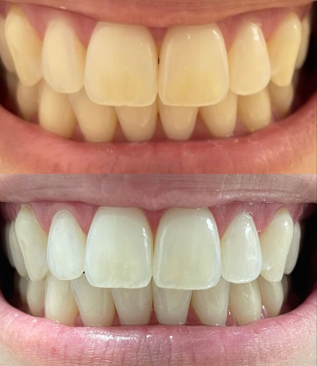 Răng Ố Vàng Nguyên Nhân Và Cách Khắc Phục Hiệu Quả