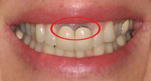 Lợi Thâm Đen Nguyên Nhân Và Cách Điều Trị Tại Nha Khoa Adent