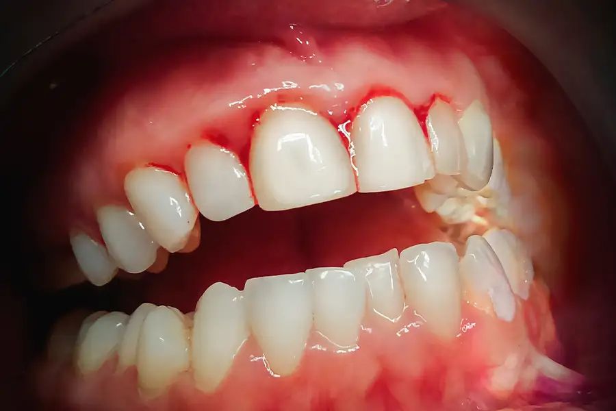 Lợi Thâm Đen Nguyên Nhân Và Cách Điều Trị Tại Nha Khoa Adent