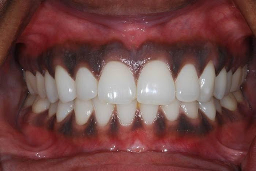 Lợi Thâm Đen Nguyên Nhân Và Cách Điều Trị Tại Nha Khoa Adent