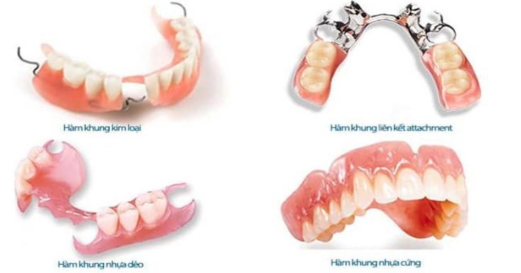 Trồng Răng Giả Tháo Lắp Tại Nha Khoa Adent