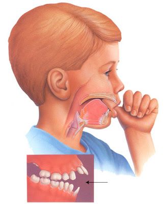 Hàm Hô Và Răng Hô Cách Phân Biệt Và Điều Trị Tại Nha Khoa Adent (1)