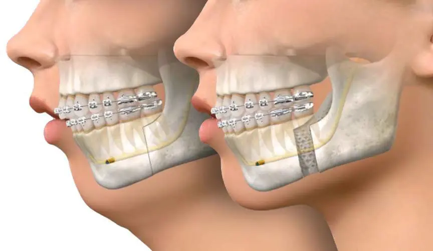 Hàm Hô Và Răng Hô Cách Phân Biệt Và Điều Trị Tại Nha Khoa Adent (1)