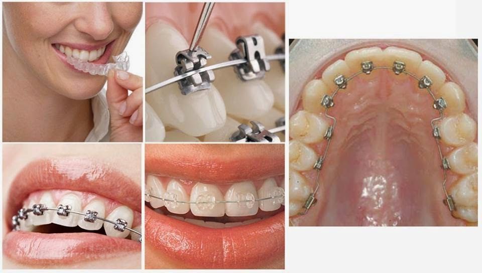 Hàm Hô Và Răng Hô Cách Phân Biệt Và Điều Trị Tại Nha Khoa Adent (3)