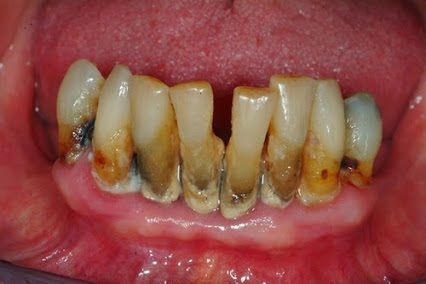 Tụt Lợi Là Gì Nguyên Nhân, Dấu Hiệu Và Cách Điều Trị