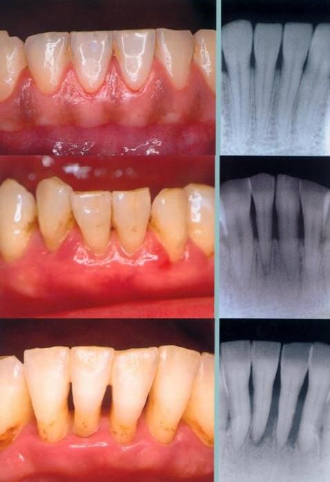 Tụt Lợi Là Gì Nguyên Nhân, Dấu Hiệu Và Cách Điều Trị