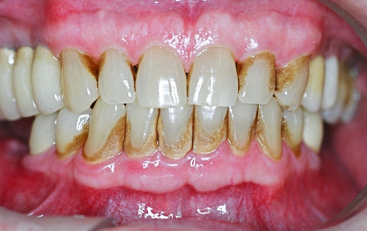 Tụt Lợi Là Gì Nguyên Nhân, Dấu Hiệu Và Cách Điều Trị