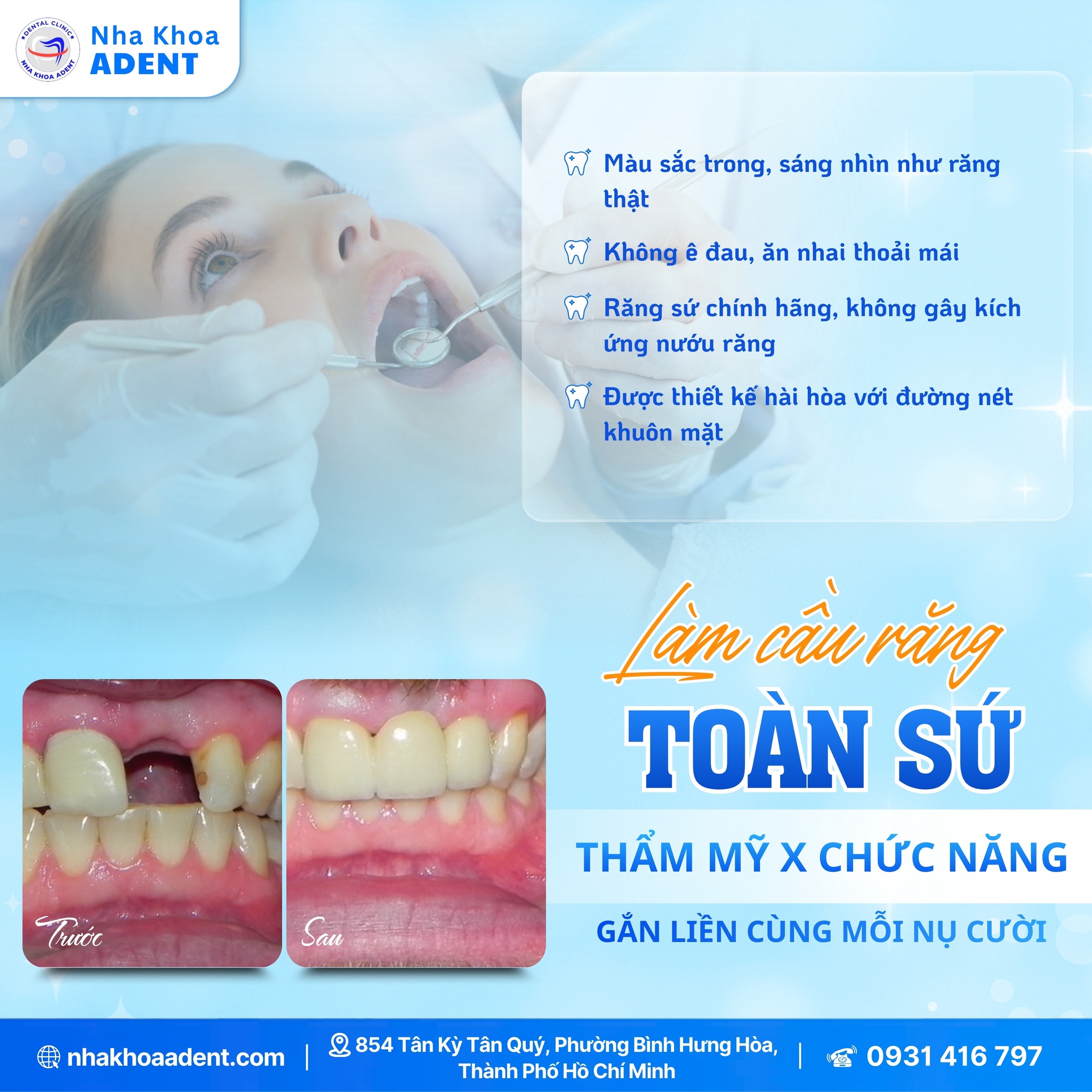 Nhược Điểm Cầu Răng Sứ – Những Điều Cần Biết Trước Khi Lựa Chọn (1)