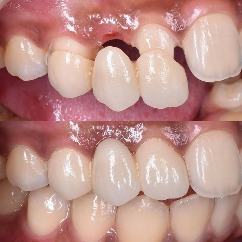 Nhược Điểm Cầu Răng Sứ – Những Điều Cần Biết Trước Khi Lựa Chọn (2)