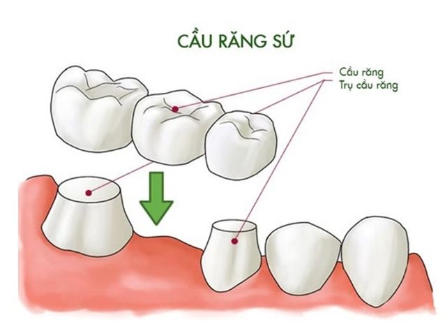 Nhược Điểm Cầu Răng Sứ – Những Điều Cần Biết Trước Khi Lựa Chọn (3)